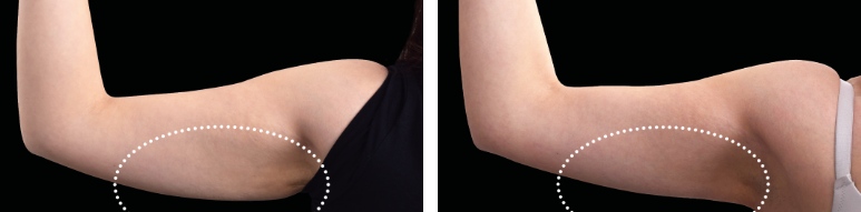 Emsculpt NEO - Before and After Treatment Effect