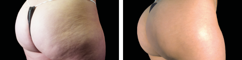 Before After Effect on Hip with Emsculpt NEO