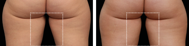 Before After Effect on Hip and Thigh with Emsculpt NEO