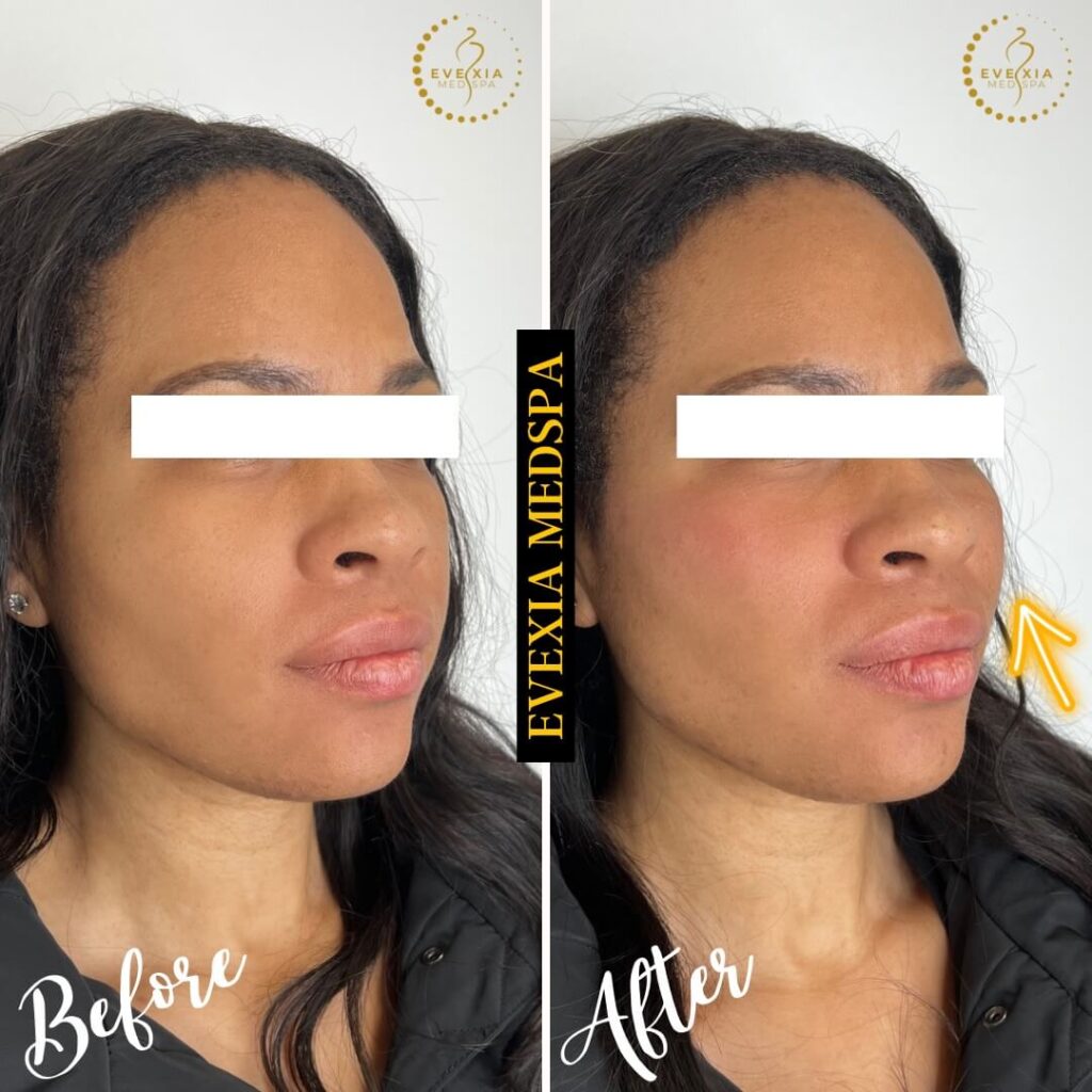 Dermal Fillers before and after showing an enhanced lip shape from Evexia Medspa in Mclean, VA.