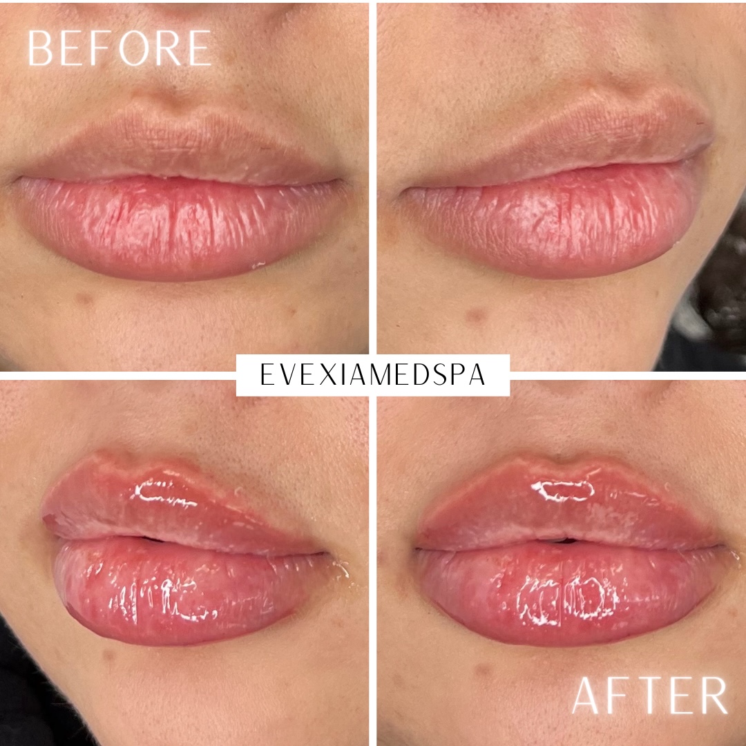 Dermal Fillers Mclean Va Face And Lip Fillers