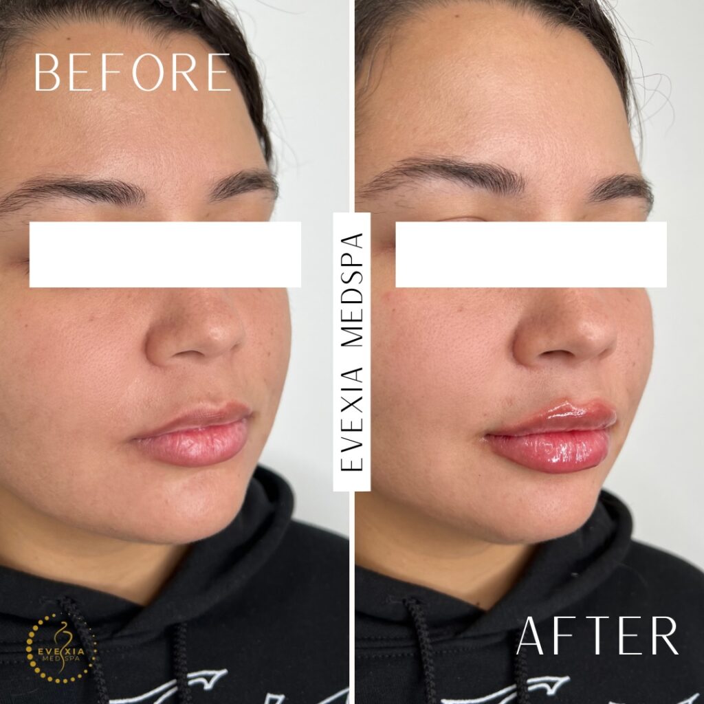Dermal filler before and after photos showing an increased volume and shape of the lips.