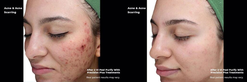 Before and after results of chemical peel treatment for acne breakout in McLean, VA