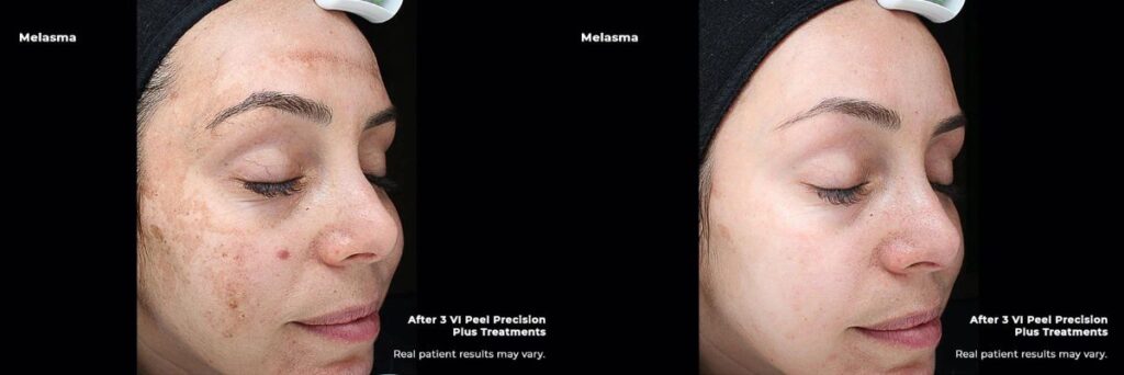 Before and after images of melasma chemical peel treatment in McLean, VA