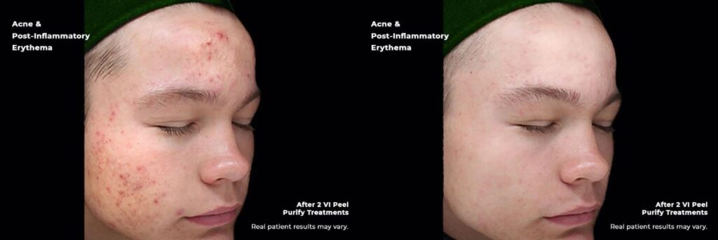 Before and after results of chemical peel treatment for acne scars in McLean, VA