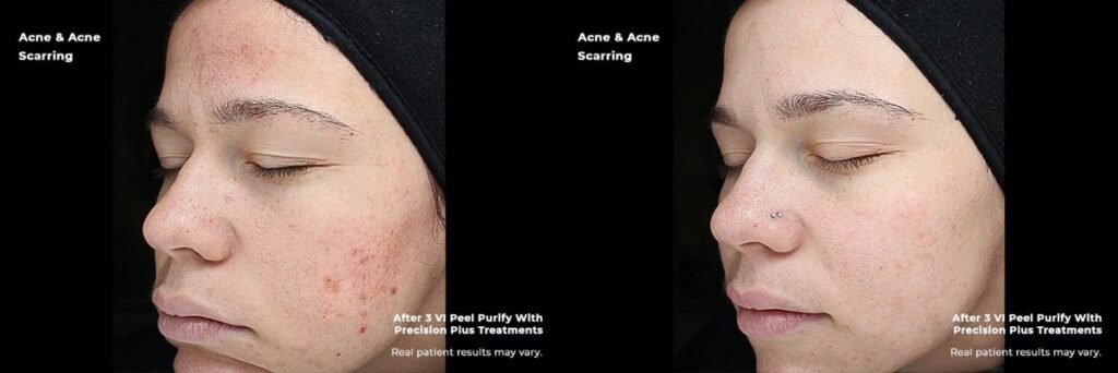Before and after images of chemical peel treatment for acne scarring in McLean, VA