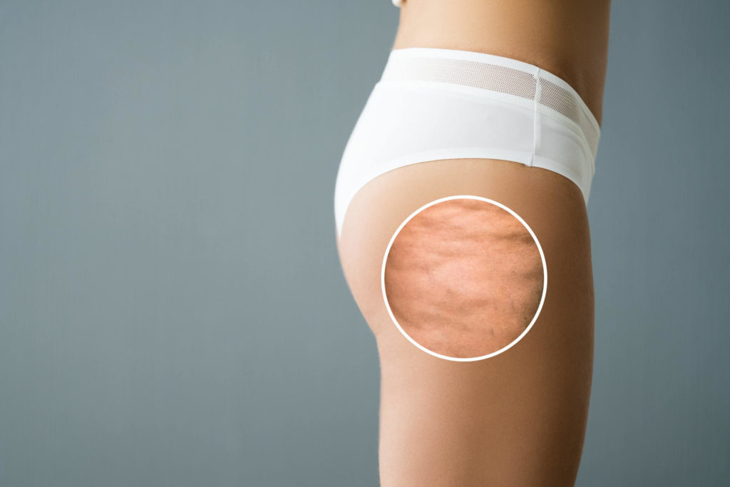 Woman's thigh showing the effects of cellulite treatment in McLean, VA.