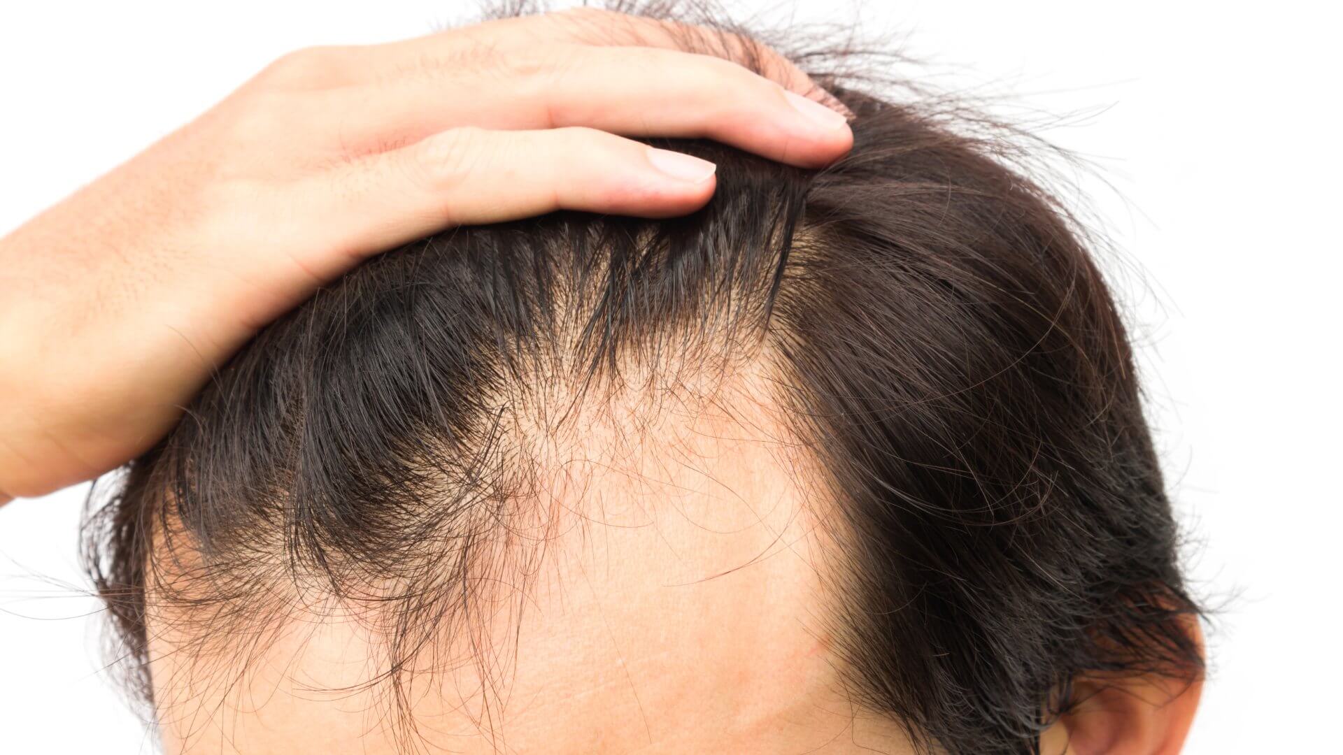 Hair Removal and Hair Restoration: We’ve Got Both!