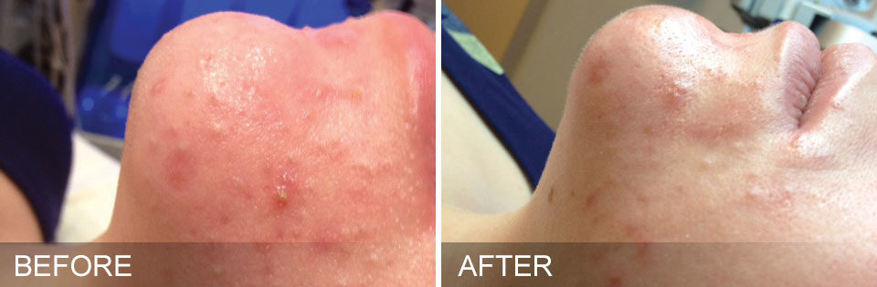 Before and after images of acne breakout from a hydrafacial treatment in McLean, VA
