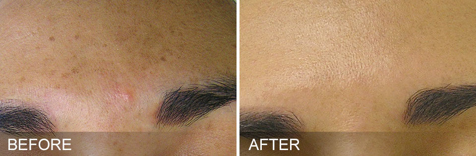 Before and after images of acne blemishes from a hydrafacial treatment in McLean, VA