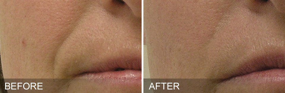 Before and after images of smile lines from a hydrafacial treatment in McLean, VA
