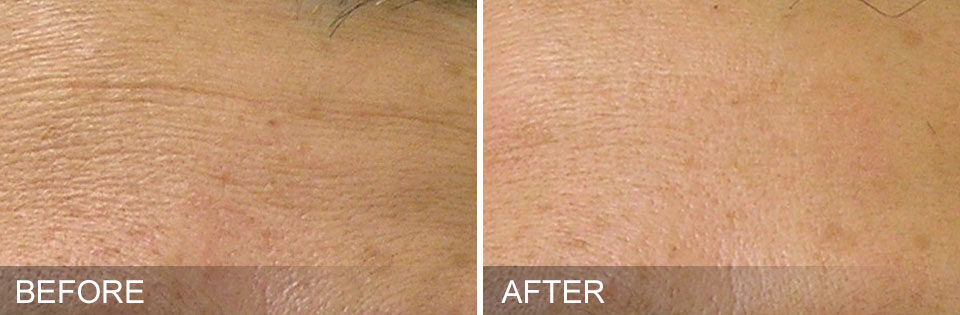 Before and after images of a forehead from a hydrafacial treatment in McLean, VA