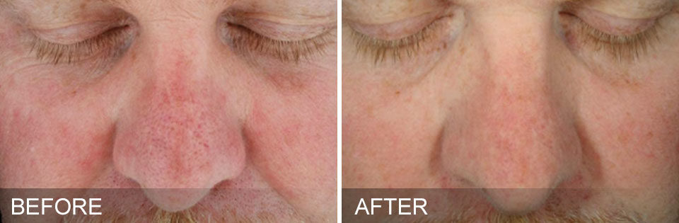 before and after images of a male face from a hydrafacial treatment in McLean, VA