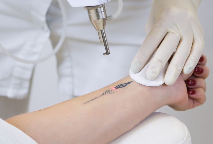 A closeup image of an arm undergoing a tattoo removal treatment, from services at Evexia Medspa in Tysons Corner, VA.