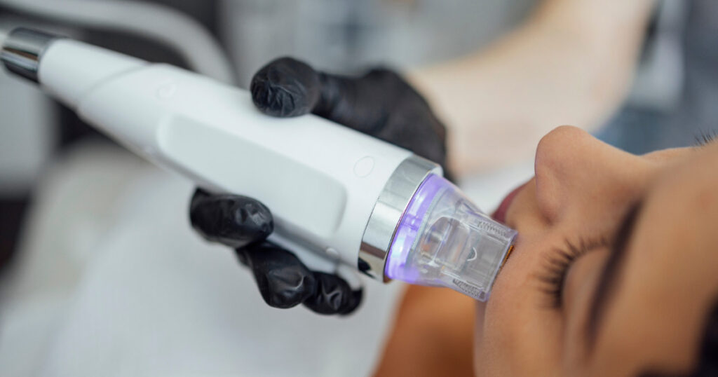 someone getting rf microneedling 1024x538 1
