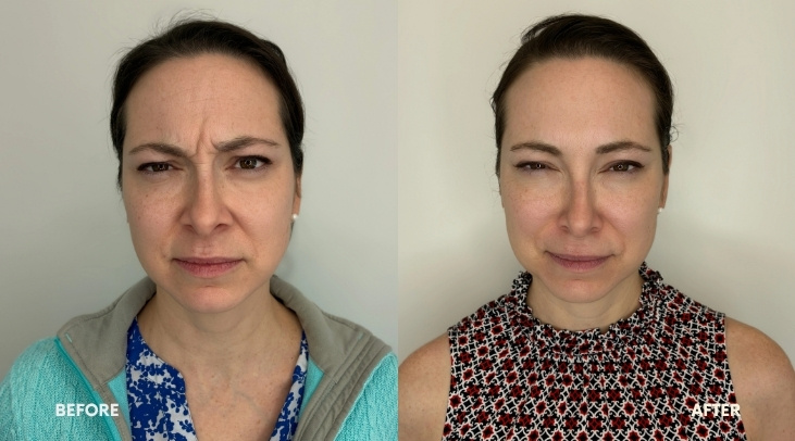 Botox 18 Botox Evexia Medspa McLean VA BA 4 image