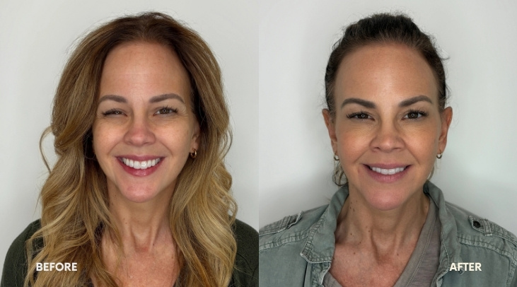 Botox 19 Botox Evexia Medspa McLean VA BA 5 image
