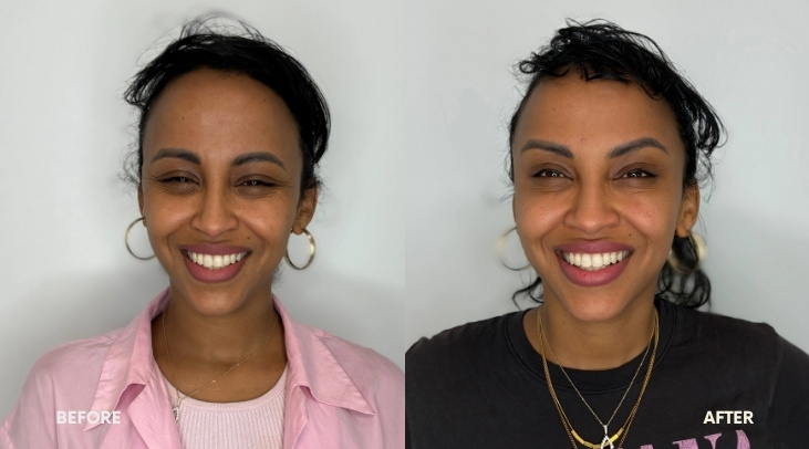 Botox 20 Botox Evexia Medspa McLean VA BA 6 image